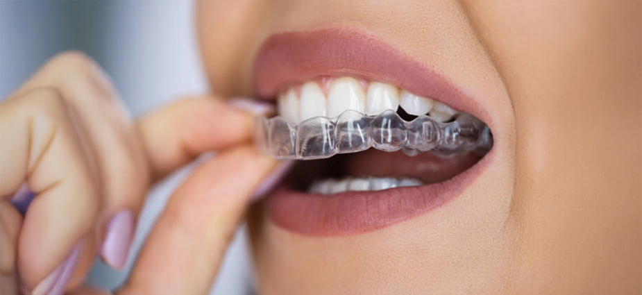 invisalign